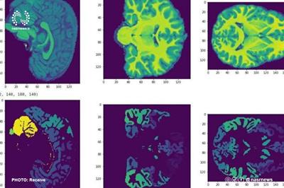 پیش‌بینی سطح هوش کودکان با MRI