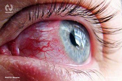  التهاب چشم یکی از نشانه‌های تهاجم کرونا است