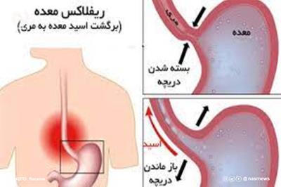 رفلاکس معده چیست: 9 راه پیشگیری از رفلاکس معده