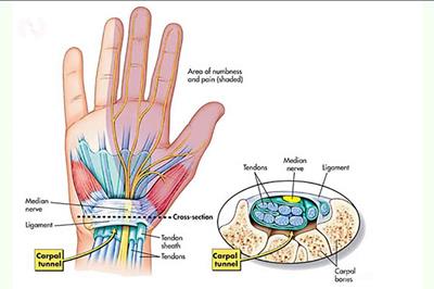 تونل کارپال چیست؟