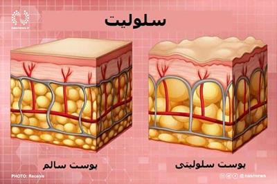 سلولیت چیست و چگونه می توان آن را درمان کرد؟