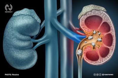  درمان سنگ‌ کلیه با کمترین درد و بدون نیاز به بیهوشی