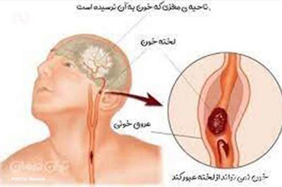 اختراع دستگاه هشداردهنده لخته خون به همت مخترع پارس‌آبادی