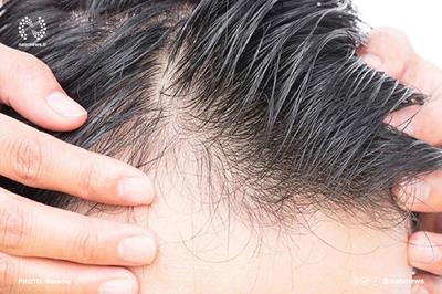 برای اینکه ریزش مو نگیرید این ۵ ماده غذایی را کمتر بخورید