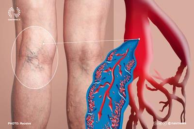 رژیم غذایی مناسب برای جلوگیری از ترومبوز سیاهرگی عمقی