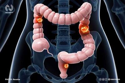 استاتین ها در مبارزه با رشد تومور سرطان روده موثرند