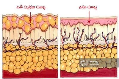 «سلولیت» چیست و چرا در زنان شایع‌تر است؟