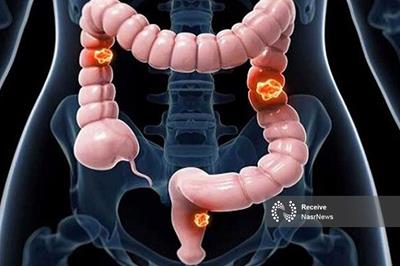 پیش بینی اولیه خطر ابتلا به سرطان روده