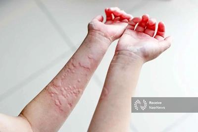 چرا استرس باعث بروز کهیر می شود؟